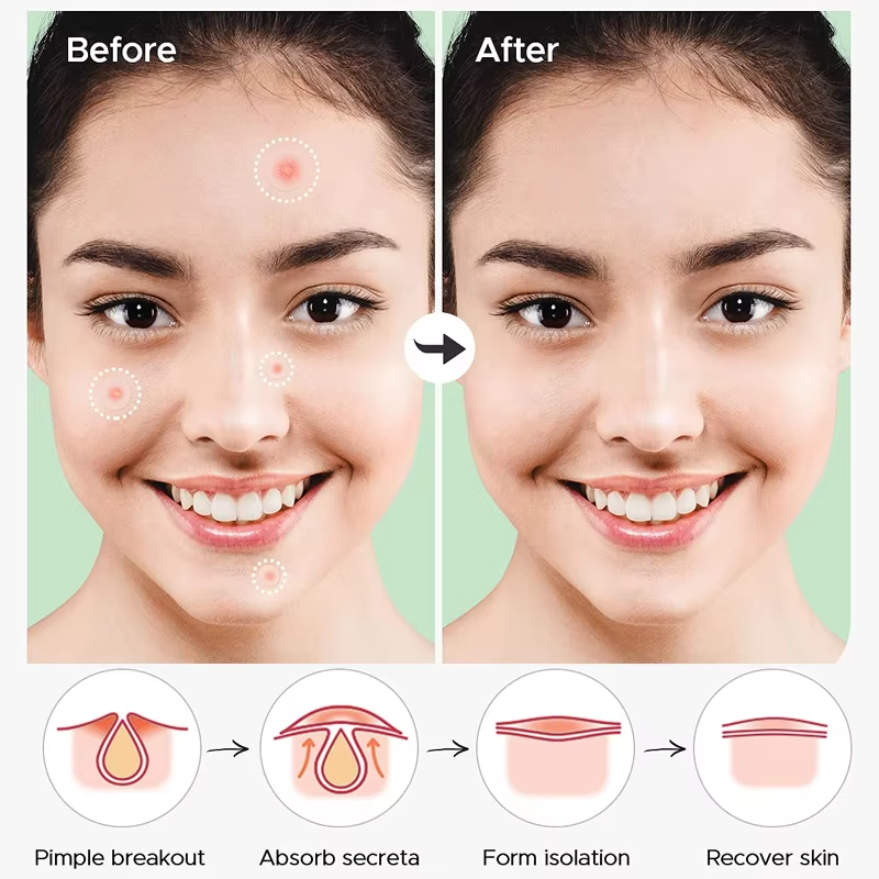 Patchs Anti-Acné Hydrocolloïde — Traitement Local et Rapide des Boutons