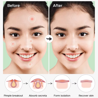 Patchs Anti-Acné Hydrocolloïde — Traitement Local et Rapide des Boutons