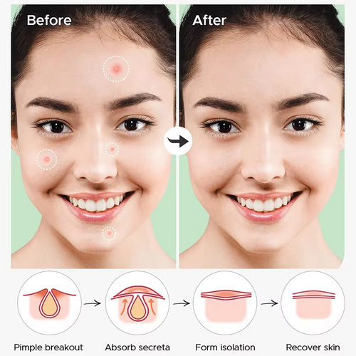 Patchs Anti-Acné Hydrocolloïde — Traitement Local et Rapide des Boutons
